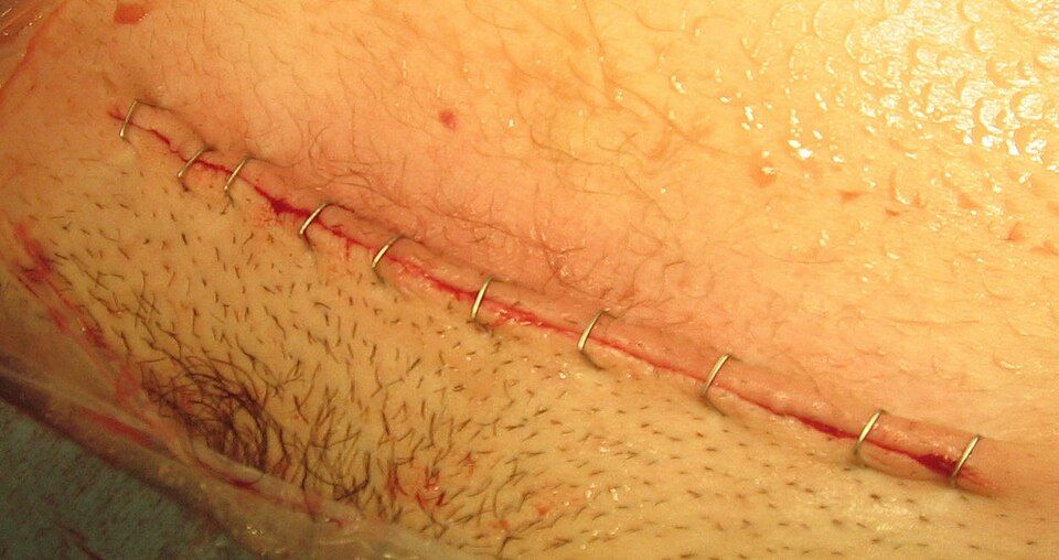 Datoteka:C-sec suture.jpg