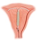 Hormonski intrauterini uložak (spirala) s prikazom položaja nakon uvođenja u uterus